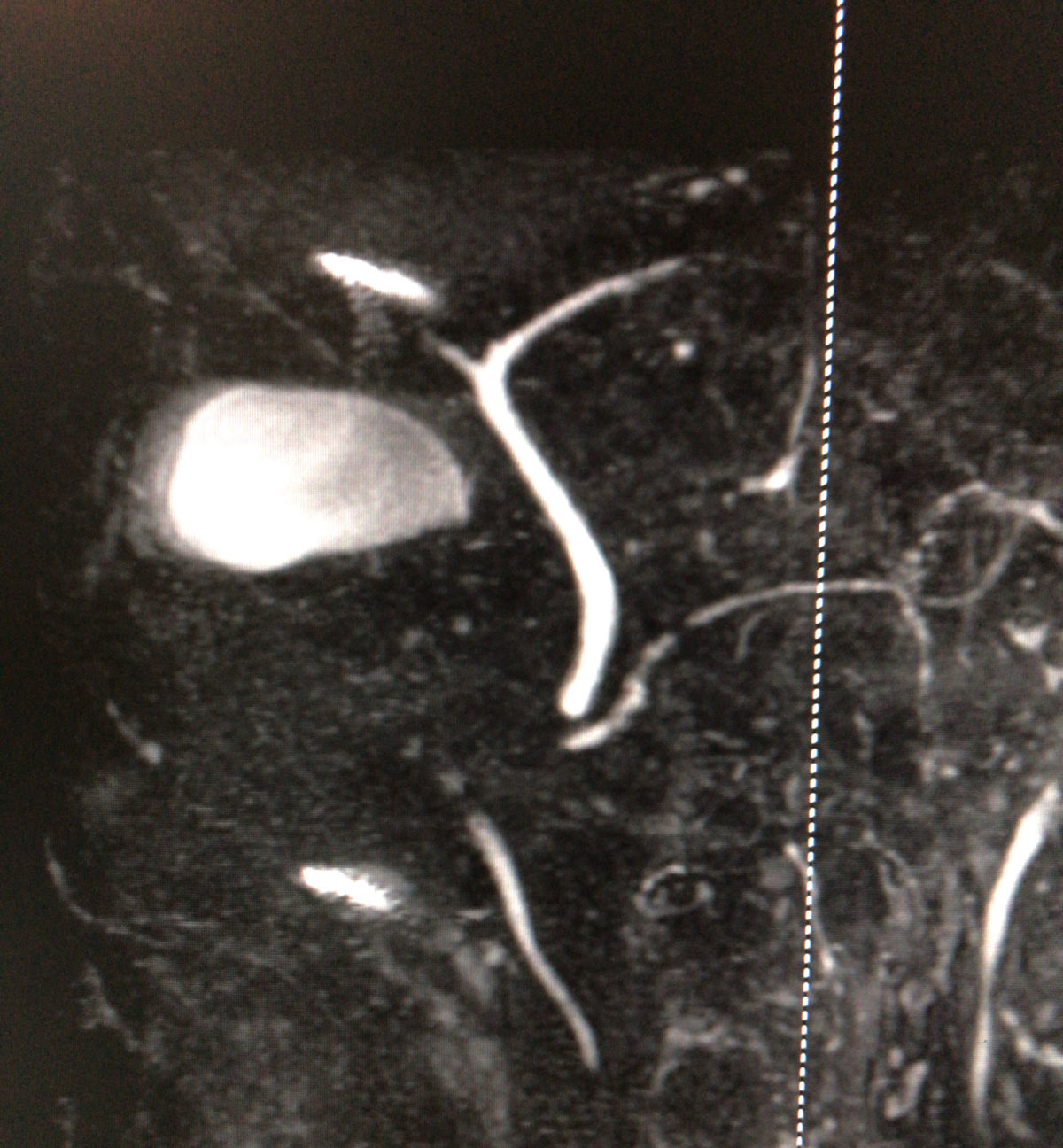 胆嚢と胆管　MRCP